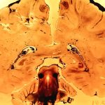 Crosssection of a human head showing exposed brain and skull interior in a yellowed preserved specimen Orientation appears upside down in this image