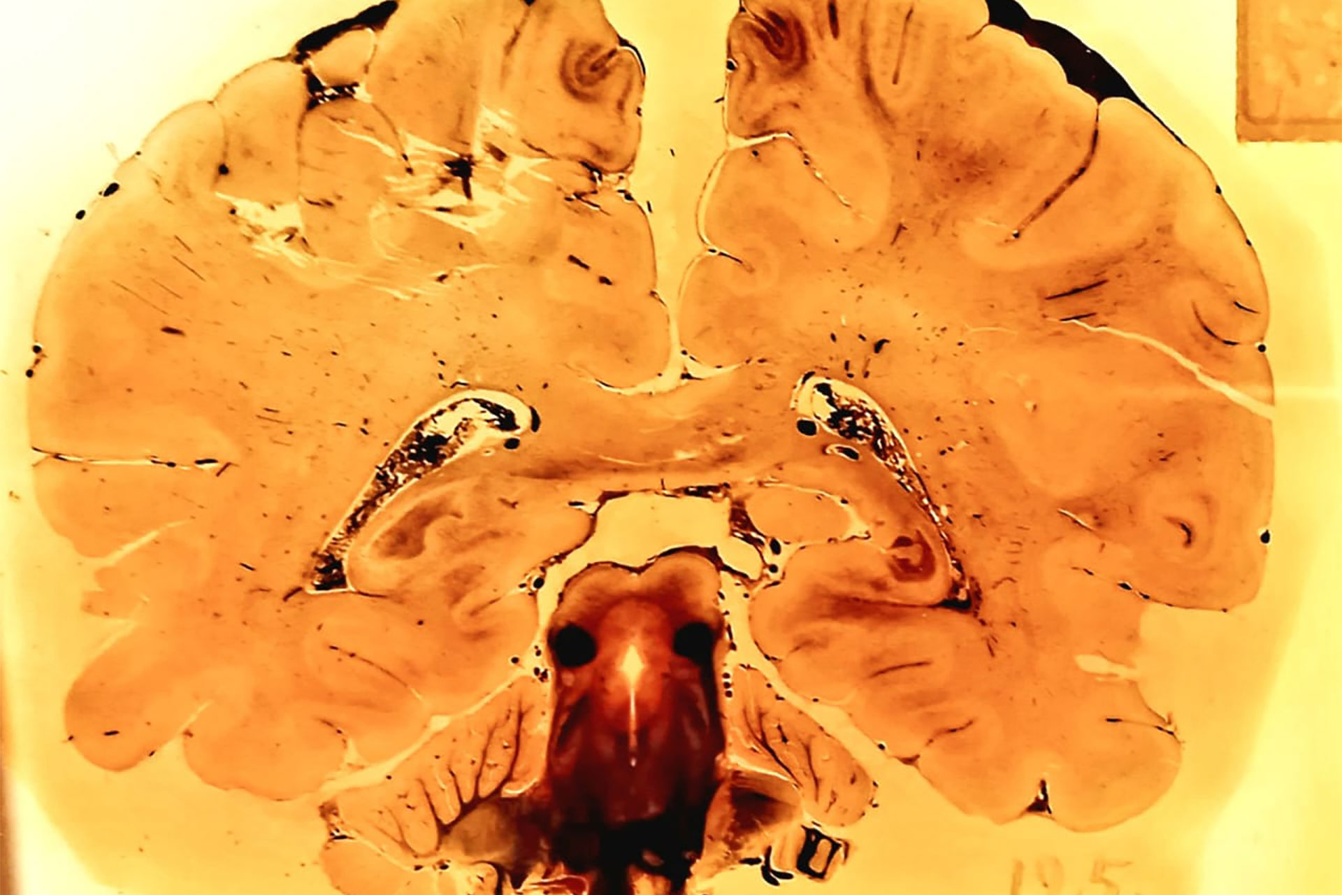 Cross‑section of a human head showing exposed brain and skull interior in a yellowed preserved specimen. Orientation appears upside down in this image.